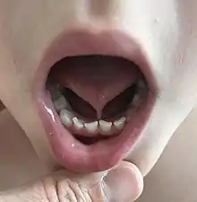 A photo showing a child with ankyloglossia. The lingual frenulum connecting the bottom of the tongue to the floor of the mouth is shorter and thicker than normal.