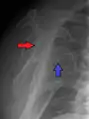 Anterior dislocation of the right shoulder. Y view X ray.