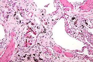 Micrograph of asbestosis with prominent ferruginous bodies. H&E stain.