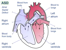 Atrial septal defect with left-to-right shunt