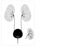 Autosomal recessive polycystic kidney disease