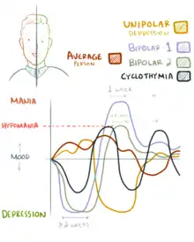 A graph showing mood lability. A neurotypical experiences a variety that never reaches hypomania or depression. Bipolar type 1 involves a manic episode. Bipolar type 2 involves depressive and hypomanic episodes. Cyclothymia involves hypomania and semi-depressive episodes. Unipolar depression involves periods of depression with some normal moods.