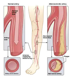 Illustration of atherosclerosis causing arterial obstruction which clinically presents at peripheral artery disease.