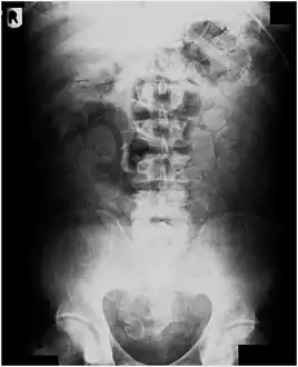 Abdominal X-ray showing small packages of cocaine swallowed by a trafficker.