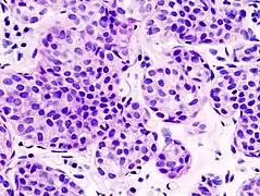 Invasive lobular carcinoma demonstrating a predominantly lobular growth pattern