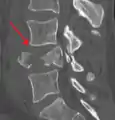 A burst fracture of L4 as seen on CT