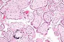 Micrograph of CMV placentitis