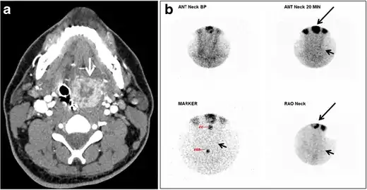 Fig. 18. Lingular thyroid in a 33-year-old male who presented with oropharyngeal bleeding. an Axial enhanced neck CT scan at the level of mandible demonstrates a 3 × 3 × 3.4 cm round, partly well-delineated, heterogeneously enhancing lesion (white arrow). It is predominantly on the left side of the oropharynx and to some extent at the mid part of the base of the tongue. The thyroid gland was normal (not shown). b Image of the anterior face and neck taken 20 minutes after Tc99m-Pertechnetate injection shows absent thyroid radiotracer uptake in normal thyroid anatomical location (black short arrows). There is an area of increased uptake (long black arrows) corresponding to the posterior tongue mass identified on CT scan.