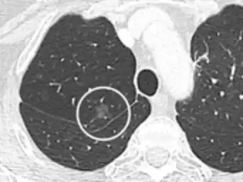 Ground glass opacity nodule.