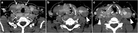 Fig. 6. A 61-year-old female patient with locally aggressive PTC. an Enhanced axial CT scan of the neck demonstrates a heterogeneous infiltrative thyroid mass. This mass diffusely involves the entire gland and circumferentially encases the trachea with involvement of bilateral tracheoesophageal grooves (white arrows). b, c Additional axial cranial images show right cricoid cartilage destruction (black arrows in b), right thyroid cartilage destruction (black arrow in c), right vocal cord paralysis (white arrows in b), and bilateral cervical lymphadenopathy (arrowheads).