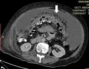 medical image showing thickened greater omentum