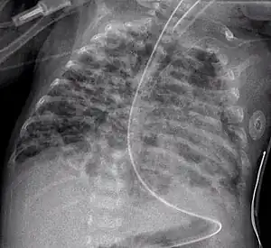 A chest radiograph showing bronchopulmonary dysplasia.