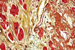 Movat's stain showing amyloid (brown) and fibrosis (yellow) of the heart.