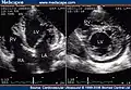 Two-dimensional apical four chamber and parasternal short axis images at the level of the ventricles show dilatation of both ventricles, multiple trabeculae and intertrabecular recesses in inferior, lateral, anterior walls, middle and apical portions of the septum and apex of the left ventricle.