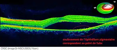 OCT in central serous chorioretinopathy