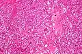 Micrograph of cerebellar hemangioblastoma. HPS stain.