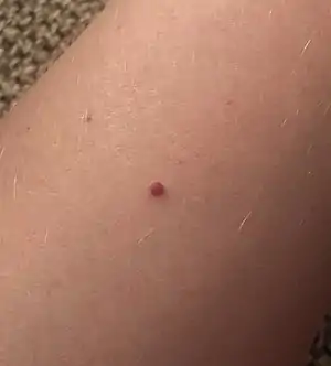 A cherry angioma on a person's arm