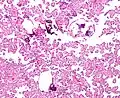 Micrograph of a choroid plexus papilloma. H&E stain.