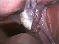 Blue dye exiting from fallopian tube