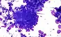 Colorectal adenocarcinoma. Field stain.