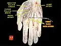 Dissection of right hands palmar side with instrument inserted under the common palmar digital arteries