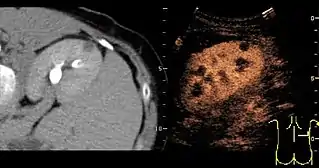 Figure 31. Unspecific cortical lesion on CT is confirmed cystic and benign with contrast-enhanced ultrasound (CEUS) using image fusion.