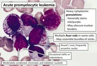 Bone marrow smear from a patient with acute promyelocytic leukemia, showing characteristic abnormal promyelocytes.