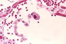 CMV infection of a human lung pneumocyte