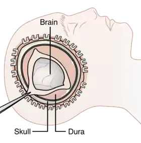 Decompressive Craniectomy