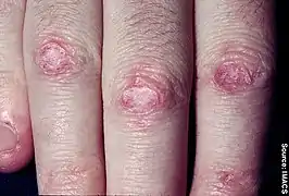 Gottron's papules