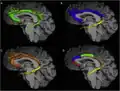 There are various ways to subdivide cingulum. From figure A to D, dividing the cingulum into 1, 2, 3, and 5 components respectively.