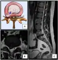 Nucleus herniating through tear in annulus (with MRI)