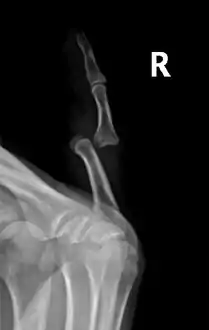 Radiograph of right fifth phalanx dislocation resulting from bicycle accident