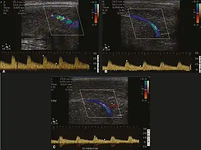 Longitudinal, ventral ultrasound of the penis, with pulsed mode and color Doppler. Flow of the cavernous arteries at 5, 15, and 25 min after prostaglandin injection (A, B, and C, respectively). The cavernous artery flow remains below the expected levels (at least 25–35 cm/s), which indicates ED due to arterial insufficiency.