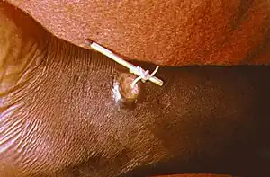 A white worm wrapped around a matchstick emerging from an open wound on a person's lower leg