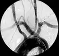 Aberrant right subclavian artery at angiography.