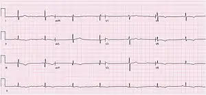 An ECG showing sinus bradycardia at 43 bpm. The image is made up of a red grid on a white background. A black line traces the patients heart beat.