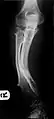 Multiple osteochondromas causing deformity of the forearm (shortening of the Radius with secondary bowing of the Ulna).