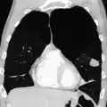 Very severe emphysema with lung cancer on the left (CT scan)