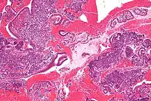 Micrograph showing endometrial stromal condensation, a finding seen in menses.