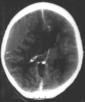 Nontraumatic epidural hematoma in a young woman. The grey area in the top right is organizing hematoma, causing midline shift and compression of the ventricle.