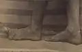 Hypertrophy of the foot, partial