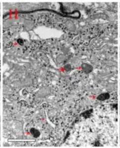 Electron microscope image of glial cell from SNc showing structures similar to ferritin in placental tissue