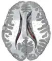 Central part and anterior and posterior cornua of lateral ventricles exposed from above.