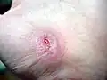 17 days after injury