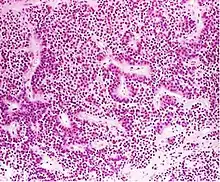 True null cell adenomas are typically composed of uniform, mildly atypical cells with chromophobic cytoplasm. This case has papillary architecture similar to gonadotroph adenomas.