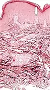 Histopathology of elastosis perforans serpiginosa: Degenerated elastic fibers and transepidermal perforating canals (arrow points at one of them)