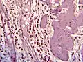 Histopathology of eosinophilic cholecystitis