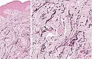 Histopathology: Accumulation of fragmented elastotic material within the papillary dermis and transcutaneous elimination of elastotic fibers.