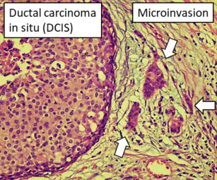 DCIS with microinvasion, defined as focus of invasive cancer measuring up to 1.0 mm in size.